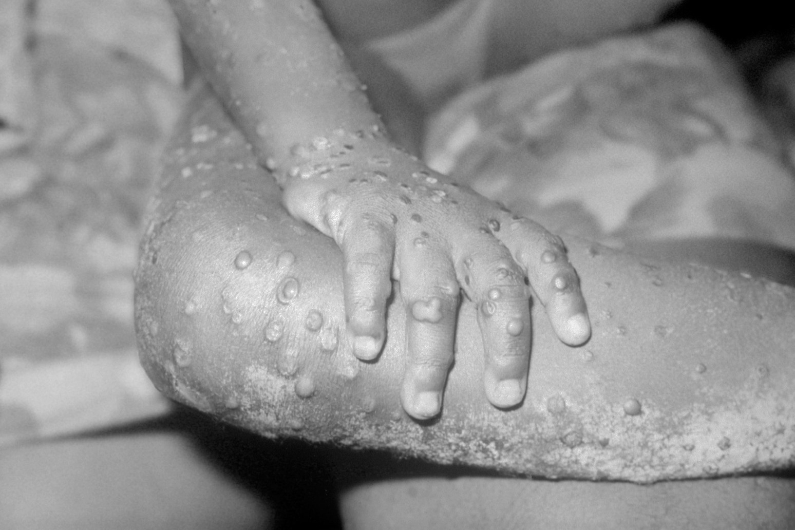 Monkeypox outbreak ‘could amplify’ during festival season – WHO 
